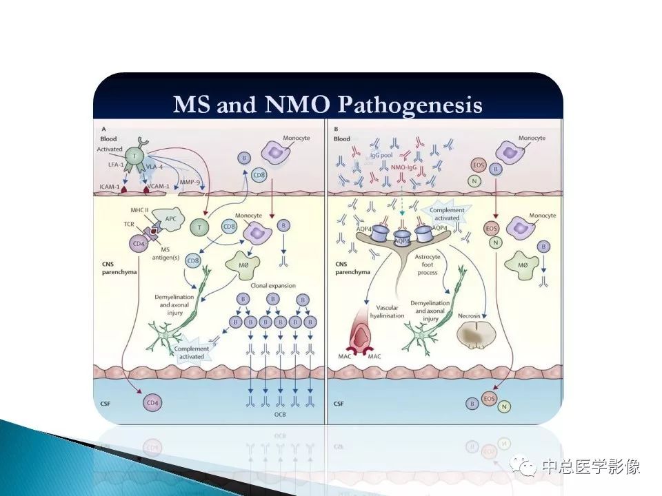 影像PPT - 【PPT】视神经脊髓炎：临床经过与MRI动态表现-43