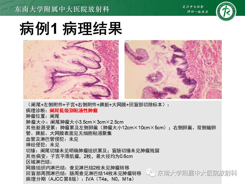 影像PPT - 【PPT】阑尾黏液性肿瘤-6 影像PPT - 【PPT】阑尾黏液性肿瘤-6