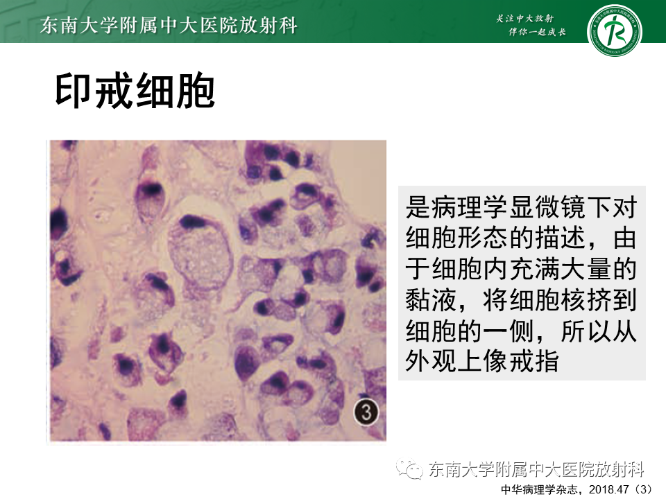 影像PPT - 【PPT】阑尾黏液性肿瘤-13 影像PPT - 【PPT】阑尾黏液性肿瘤-13