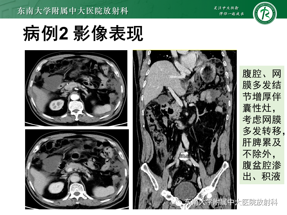 影像PPT - 【PPT】阑尾黏液性肿瘤-20 影像PPT - 【PPT】阑尾黏液性肿瘤-20