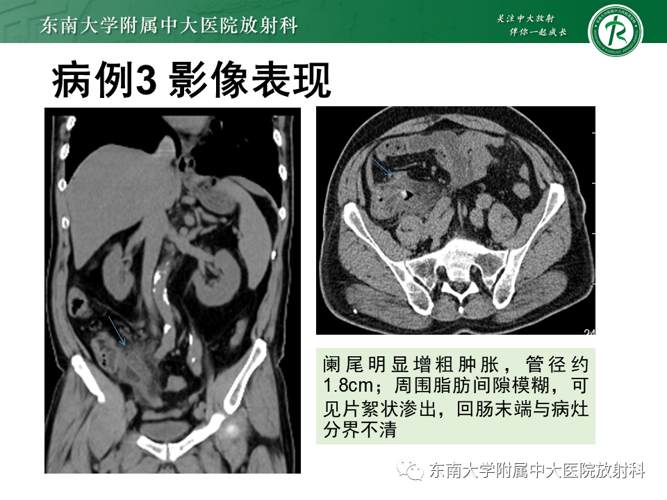 影像PPT - 【PPT】阑尾黏液性肿瘤-24 影像PPT - 【PPT】阑尾黏液性肿瘤-24