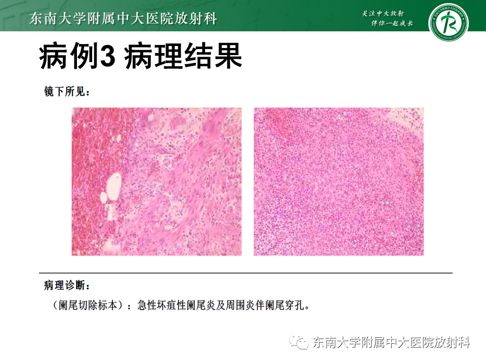 影像PPT - 【PPT】阑尾黏液性肿瘤-25 影像PPT - 【PPT】阑尾黏液性肿瘤-25