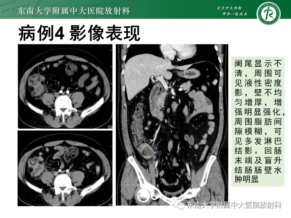 影像PPT - 【PPT】阑尾黏液性肿瘤-27 影像PPT - 【PPT】阑尾黏液性肿瘤-27