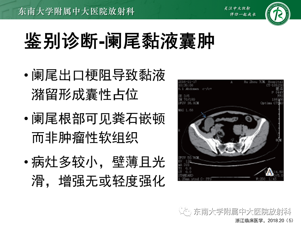 影像PPT - 【PPT】阑尾黏液性肿瘤-28 影像PPT - 【PPT】阑尾黏液性肿瘤-28