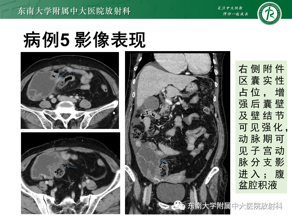 影像PPT - 【PPT】阑尾黏液性肿瘤-31 影像PPT - 【PPT】阑尾黏液性肿瘤-31