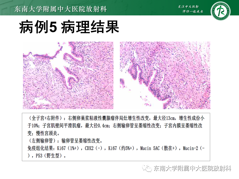 影像PPT - 【PPT】阑尾黏液性肿瘤-32 影像PPT - 【PPT】阑尾黏液性肿瘤-32