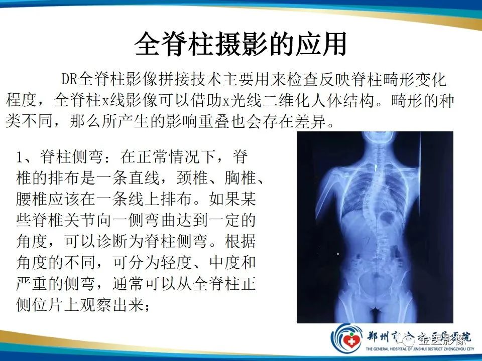 影像PPT - 【PPT】全脊柱拍片技术与临床意义-15