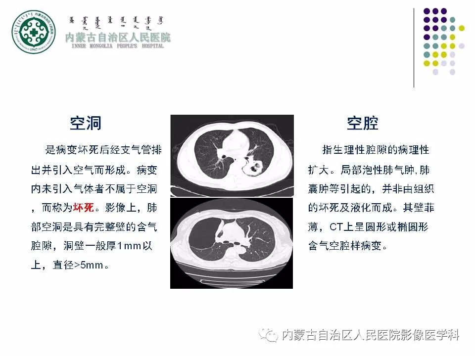 影像PPT - 【PPT】肺空洞性病变鉴别诊断-3