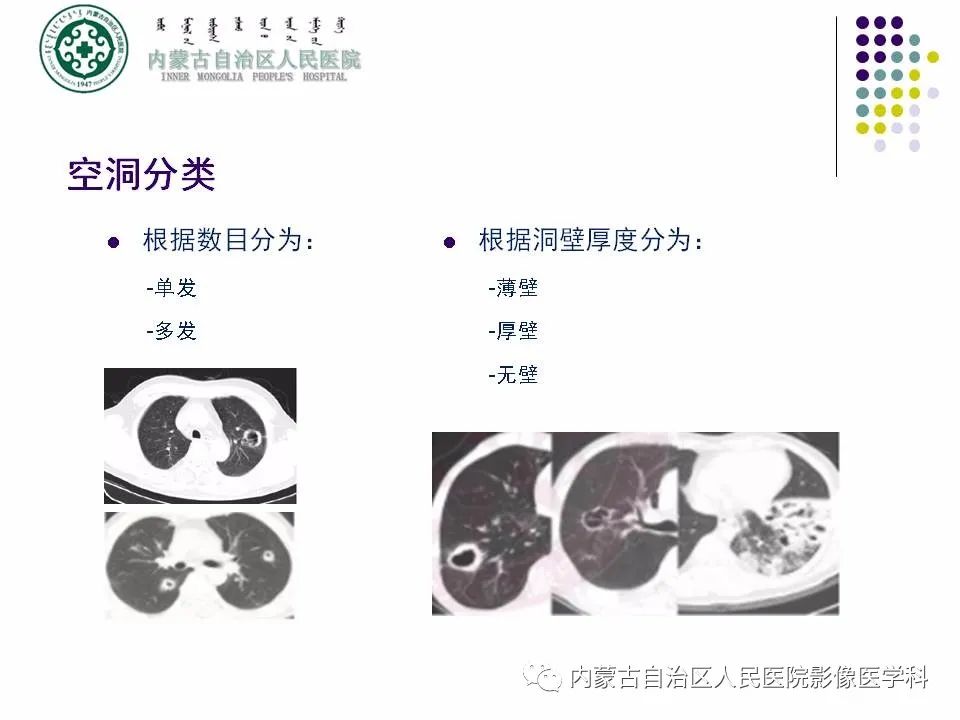 影像PPT - 【PPT】肺空洞性病变鉴别诊断-5
