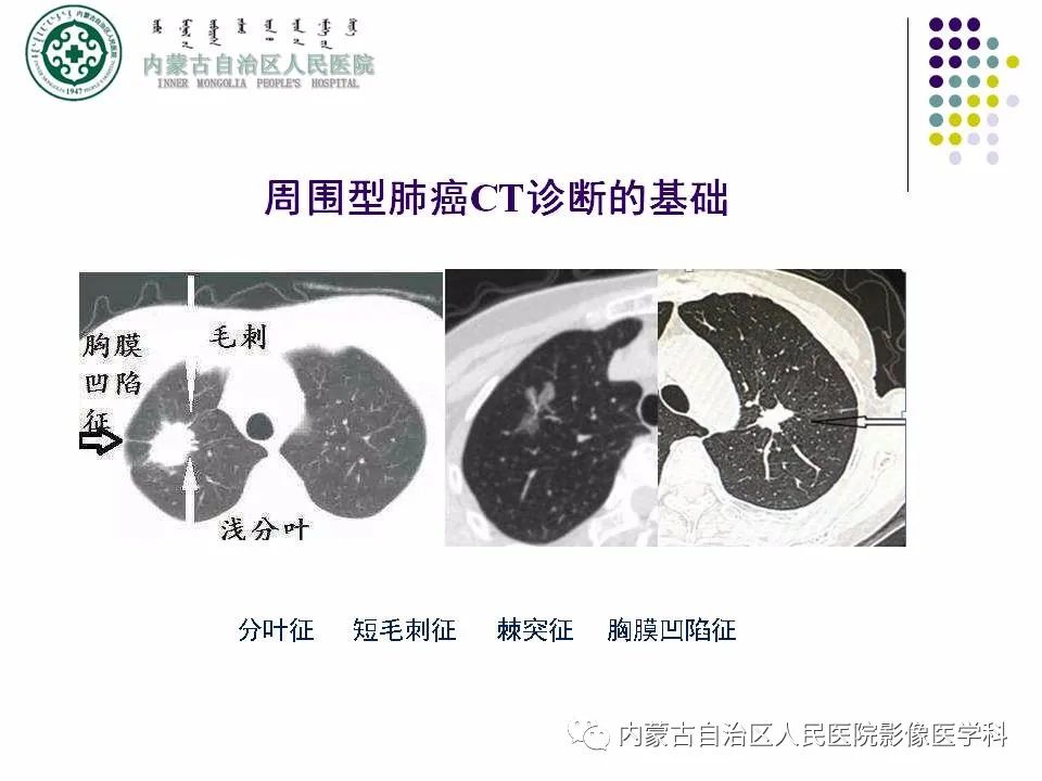 影像PPT - 【PPT】肺空洞性病变鉴别诊断-8