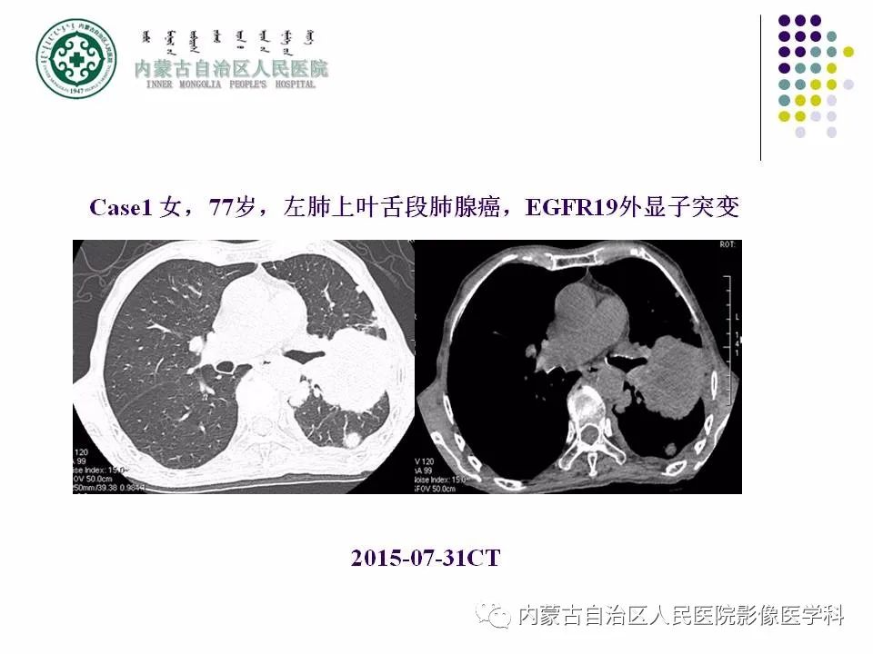 影像PPT - 【PPT】肺空洞性病变鉴别诊断-9