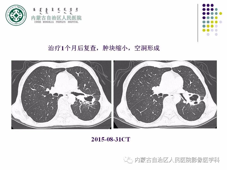 影像PPT - 【PPT】肺空洞性病变鉴别诊断-10