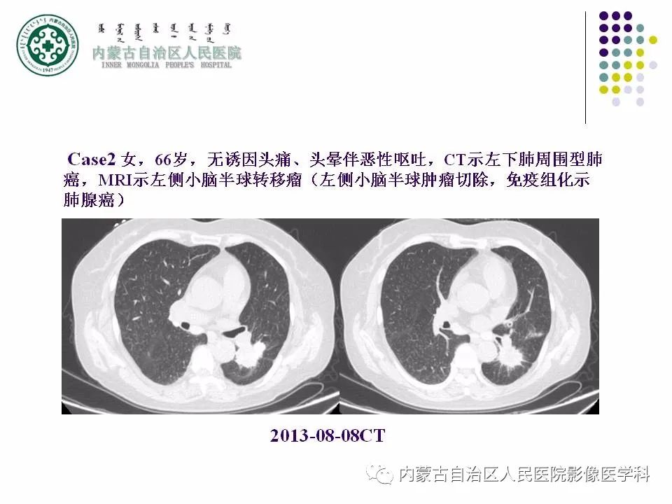 影像PPT - 【PPT】肺空洞性病变鉴别诊断-11