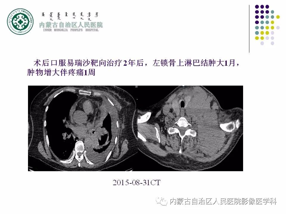 影像PPT - 【PPT】肺空洞性病变鉴别诊断-12