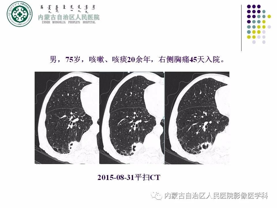 影像PPT - 【PPT】肺空洞性病变鉴别诊断-13