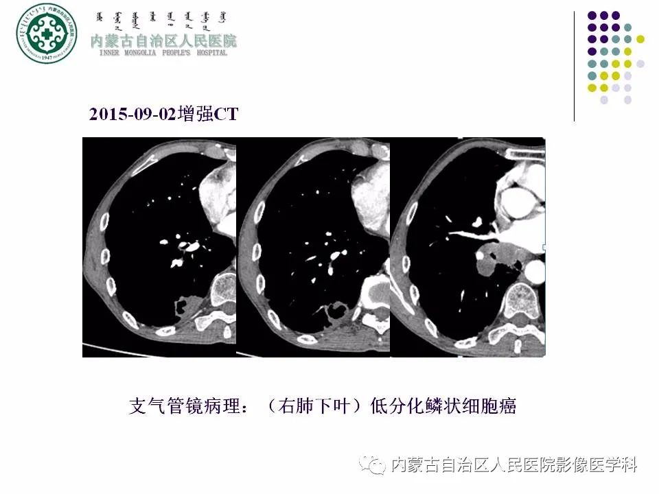 影像PPT - 【PPT】肺空洞性病变鉴别诊断-14