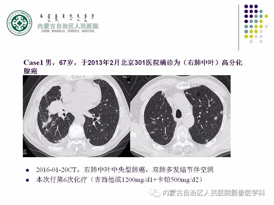影像PPT - 【PPT】肺空洞性病变鉴别诊断-17