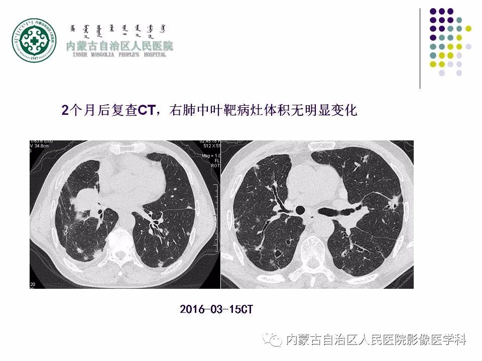 影像PPT - 【PPT】肺空洞性病变鉴别诊断-18