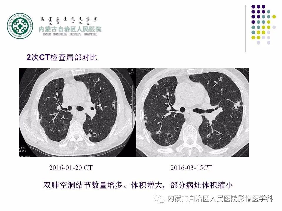 影像PPT - 【PPT】肺空洞性病变鉴别诊断-19