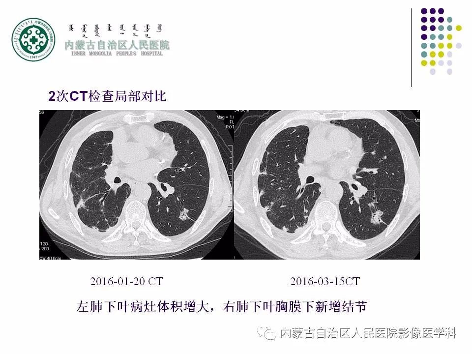 影像PPT - 【PPT】肺空洞性病变鉴别诊断-20