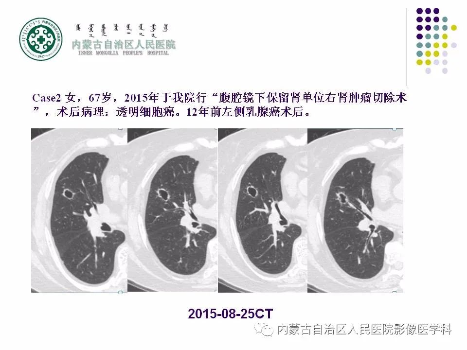 影像PPT - 【PPT】肺空洞性病变鉴别诊断-21