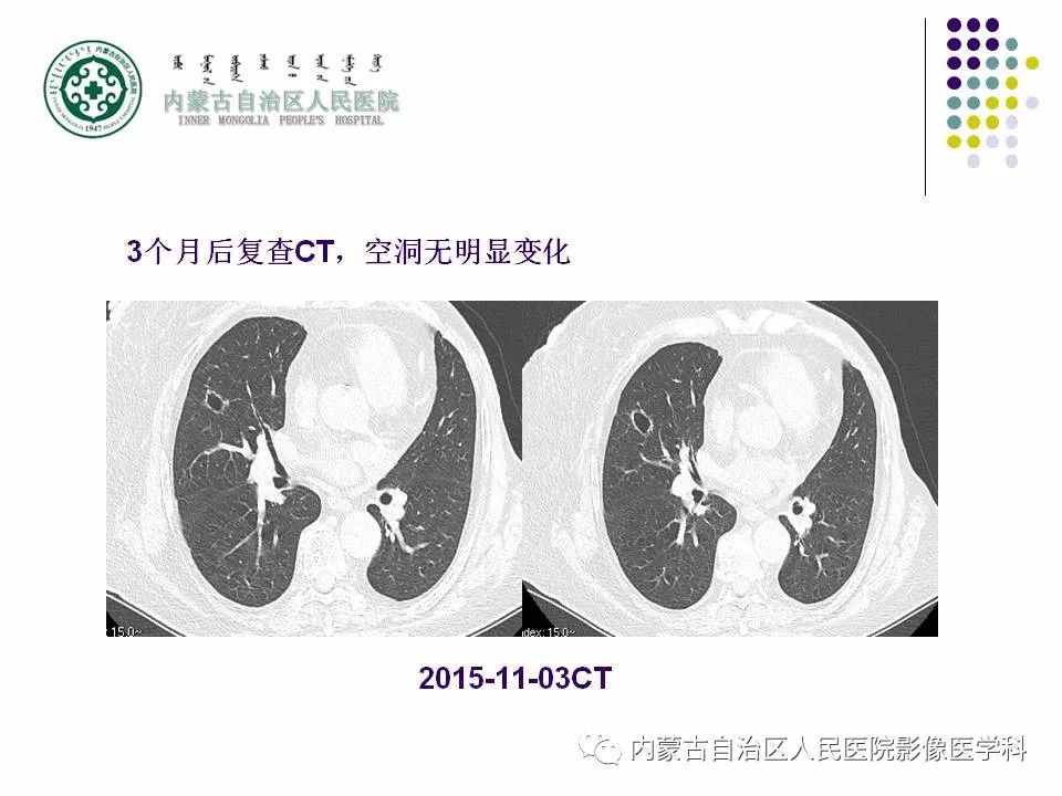 影像PPT - 【PPT】肺空洞性病变鉴别诊断-22