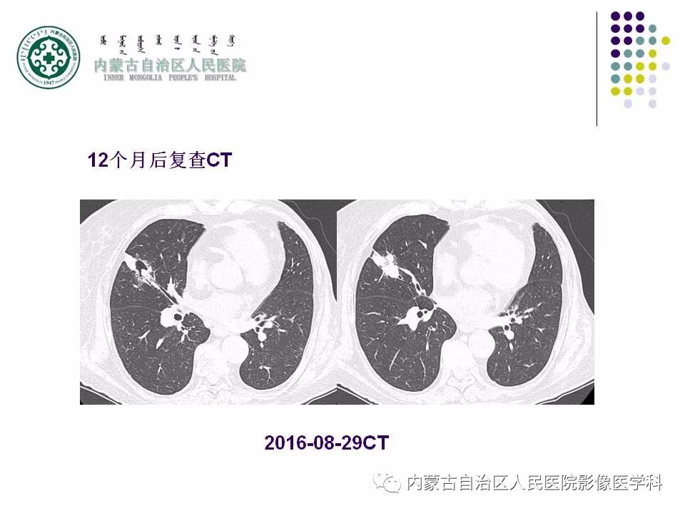影像PPT - 【PPT】肺空洞性病变鉴别诊断-24