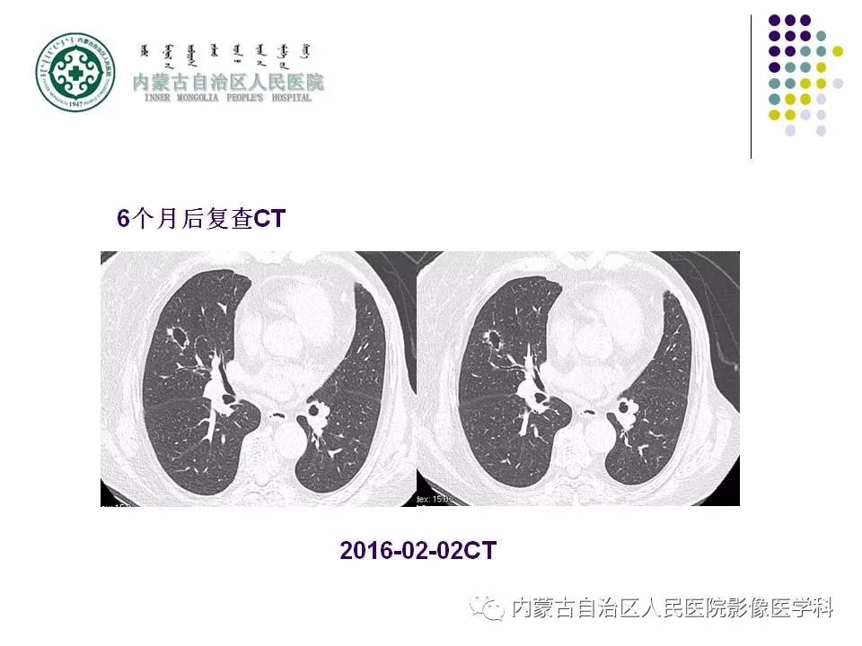 影像PPT - 【PPT】肺空洞性病变鉴别诊断-23