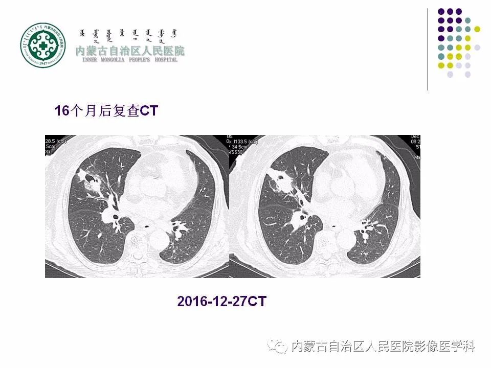 影像PPT - 【PPT】肺空洞性病变鉴别诊断-25