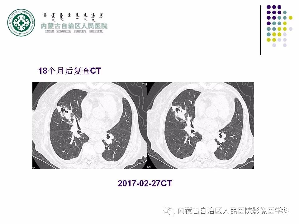 影像PPT - 【PPT】肺空洞性病变鉴别诊断-26