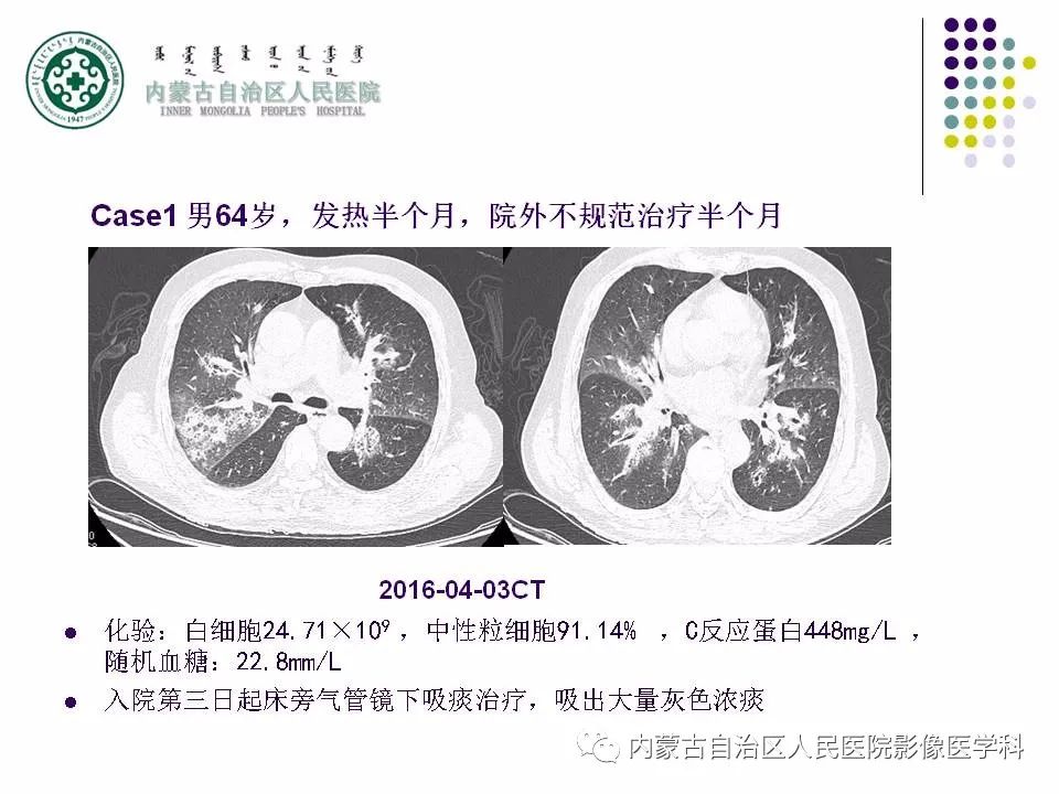 影像PPT - 【PPT】肺空洞性病变鉴别诊断-30