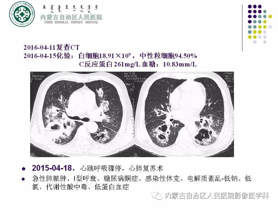 影像PPT - 【PPT】肺空洞性病变鉴别诊断-31