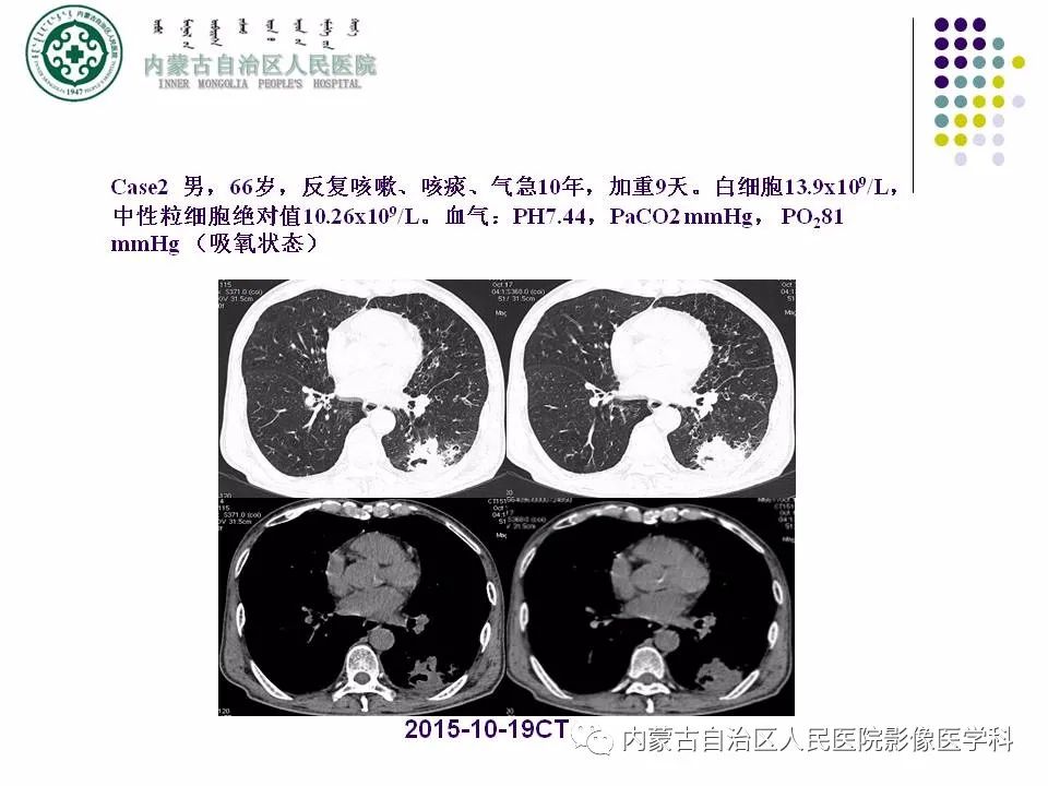 影像PPT - 【PPT】肺空洞性病变鉴别诊断-32