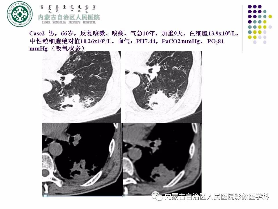 影像PPT - 【PPT】肺空洞性病变鉴别诊断-33