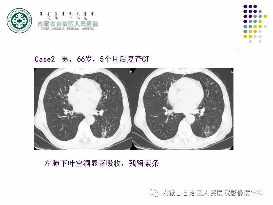 影像PPT - 【PPT】肺空洞性病变鉴别诊断-34
