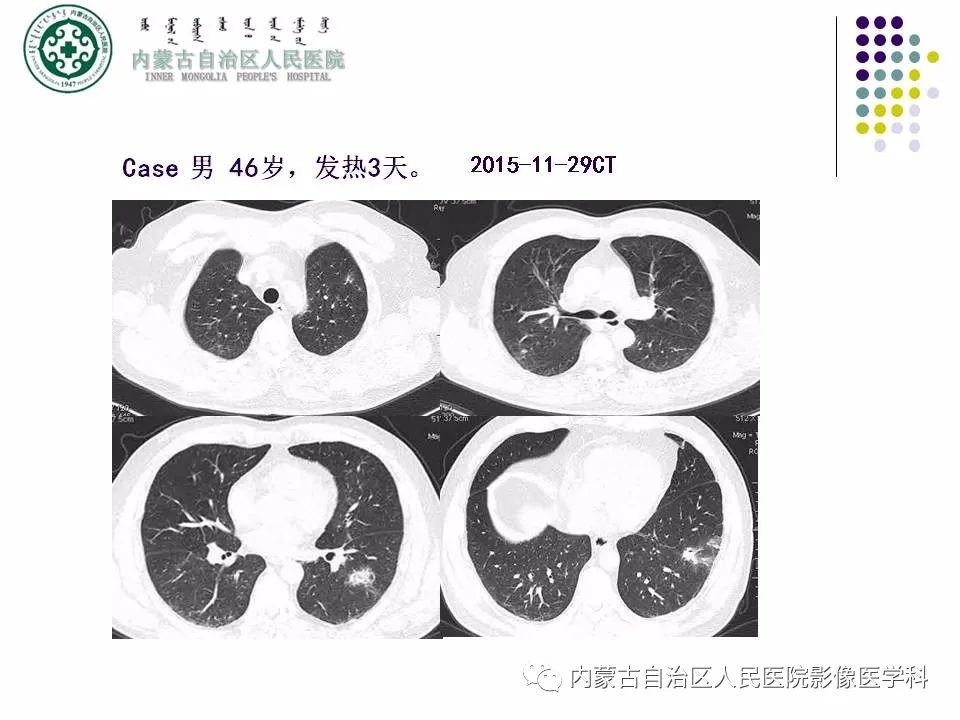 影像PPT - 【PPT】肺空洞性病变鉴别诊断-36
