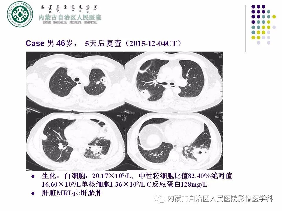 影像PPT - 【PPT】肺空洞性病变鉴别诊断-37