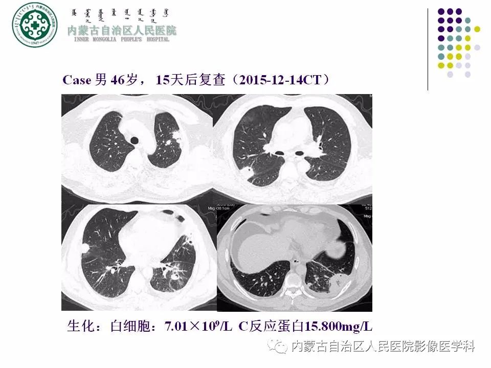 影像PPT - 【PPT】肺空洞性病变鉴别诊断-38