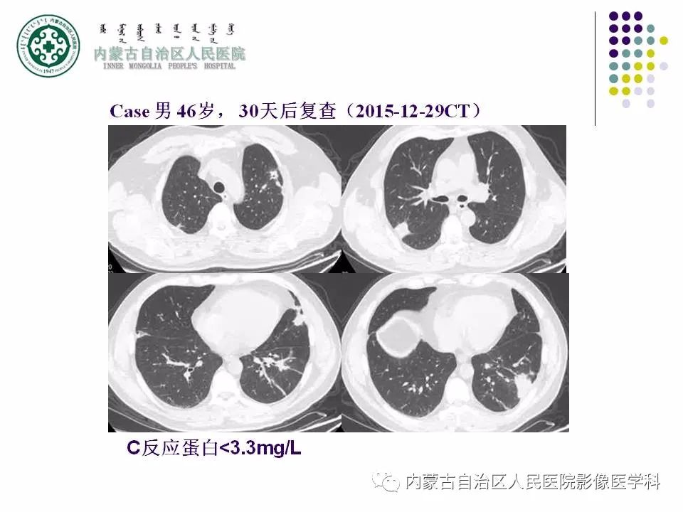 影像PPT - 【PPT】肺空洞性病变鉴别诊断-39