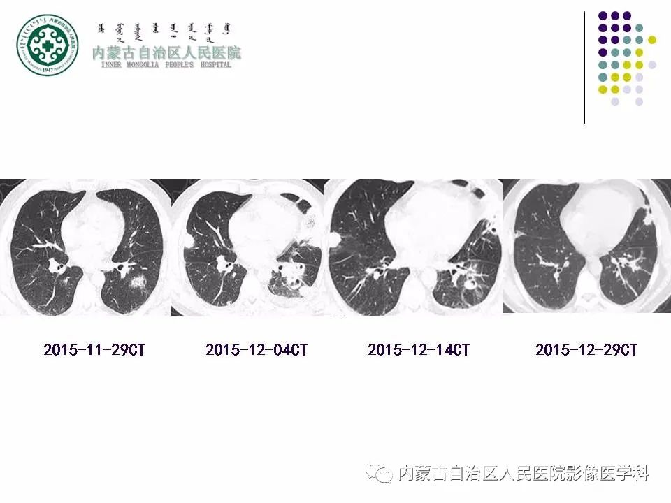影像PPT - 【PPT】肺空洞性病变鉴别诊断-40