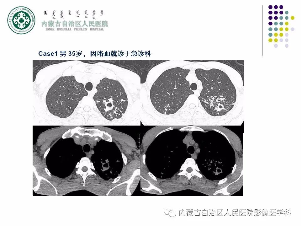 影像PPT - 【PPT】肺空洞性病变鉴别诊断-42