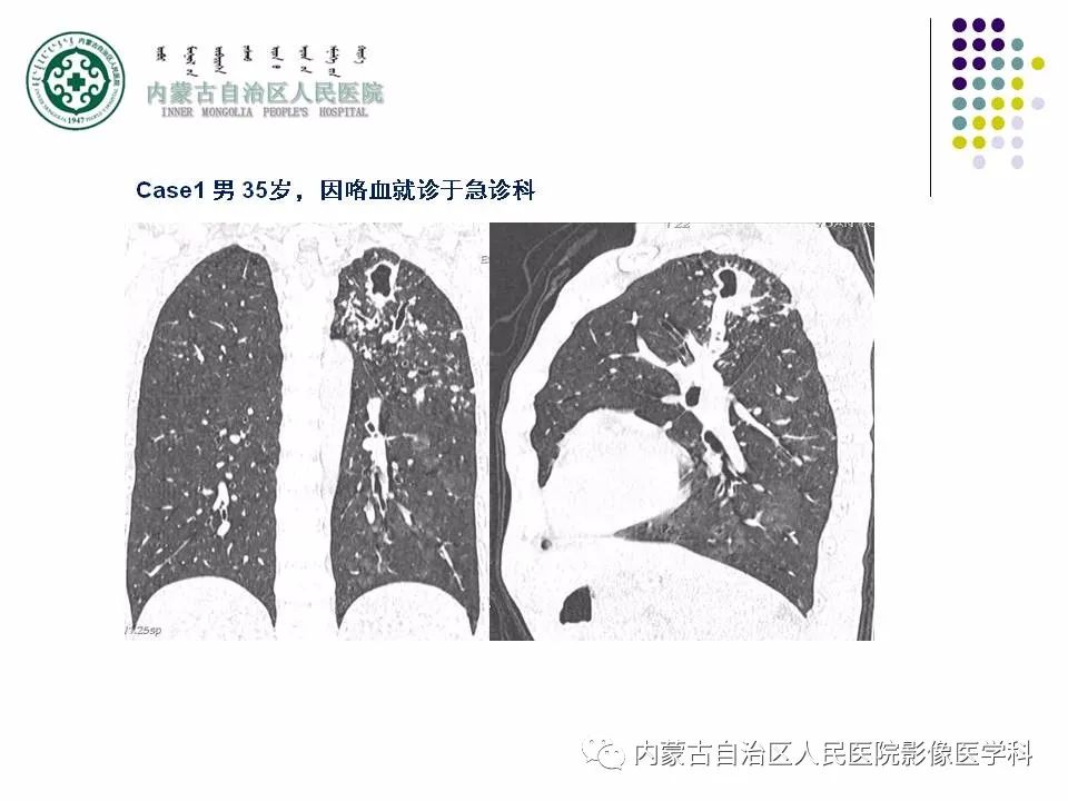 影像PPT - 【PPT】肺空洞性病变鉴别诊断-43