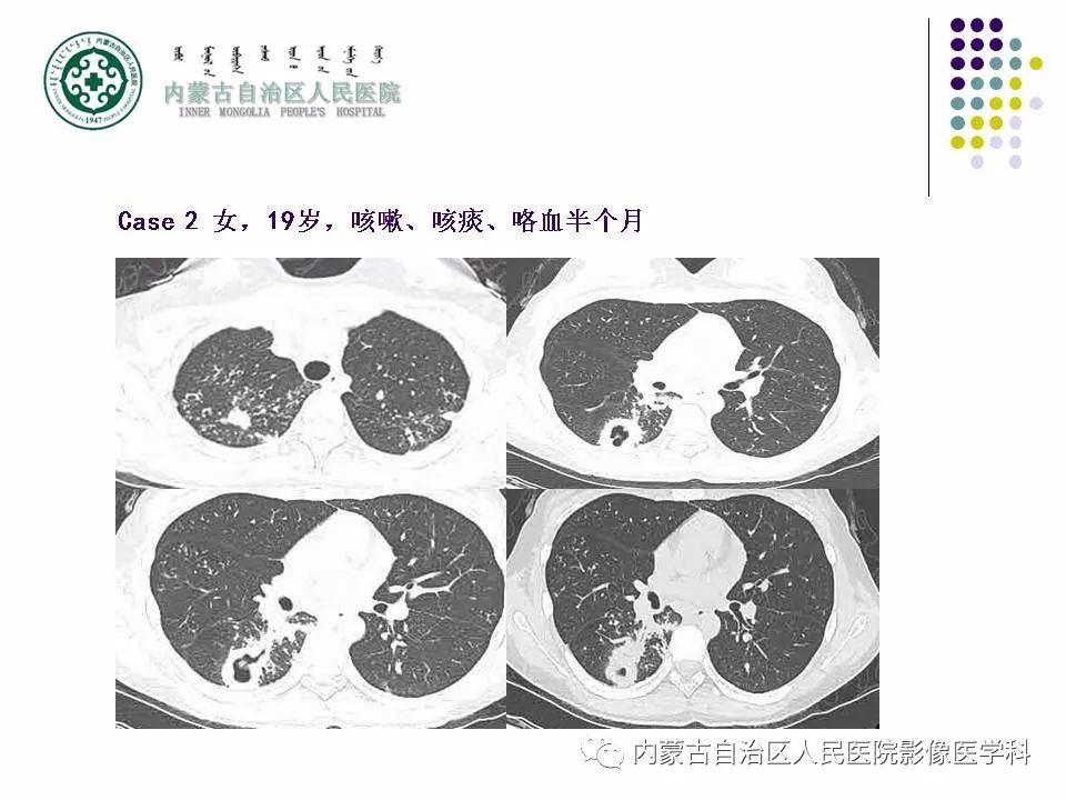 影像PPT - 【PPT】肺空洞性病变鉴别诊断-44