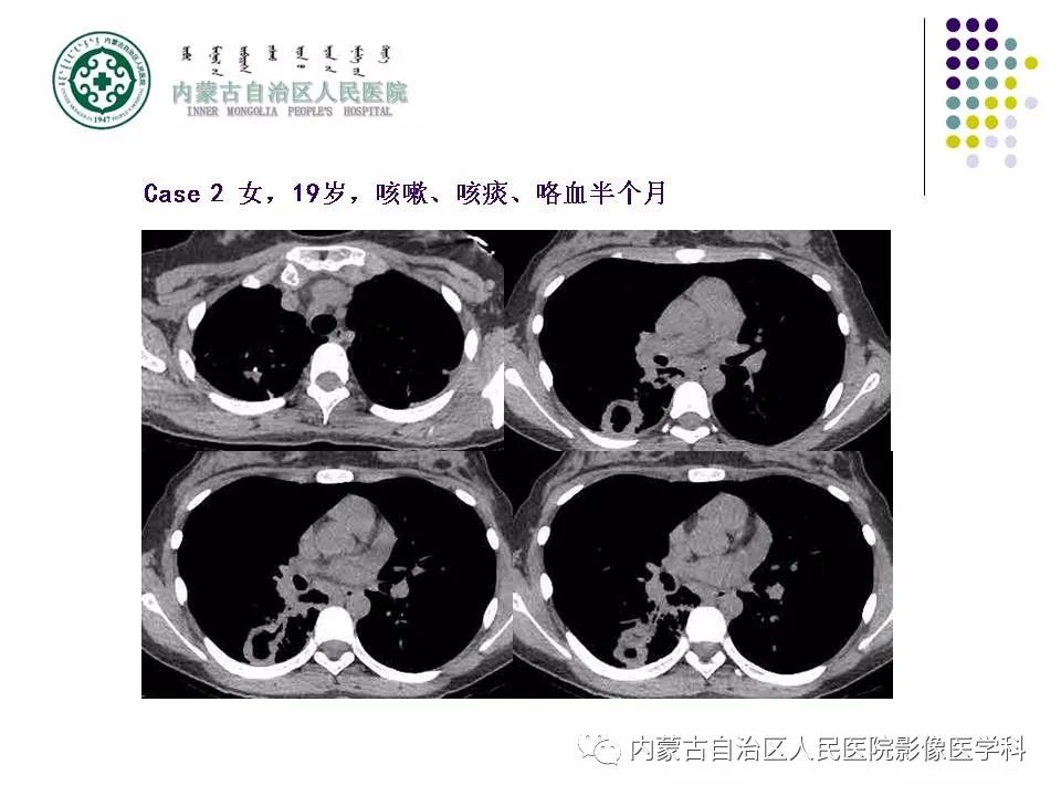 影像PPT - 【PPT】肺空洞性病变鉴别诊断-45
