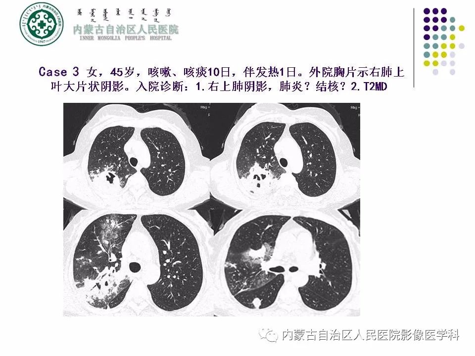 影像PPT - 【PPT】肺空洞性病变鉴别诊断-46