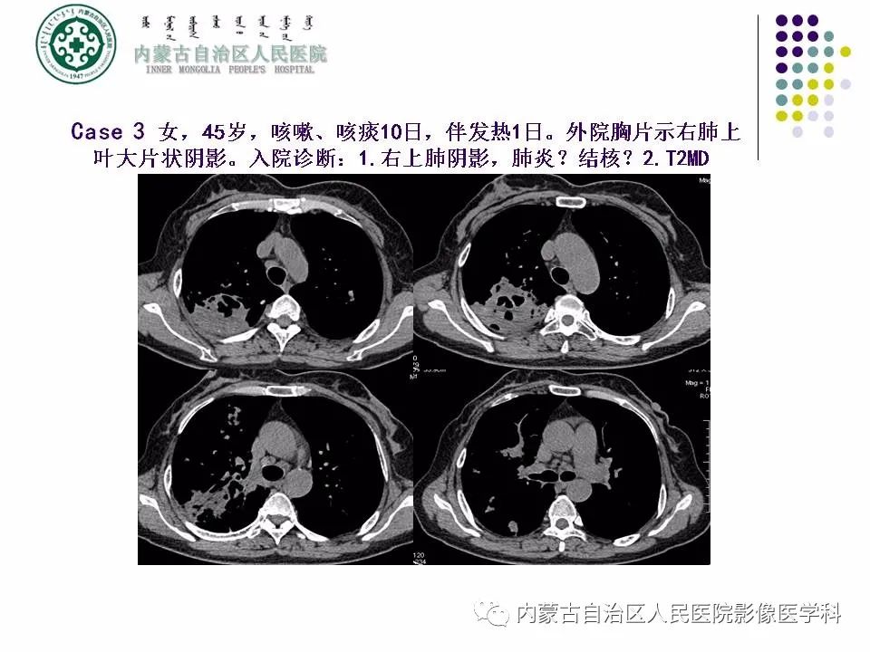 影像PPT - 【PPT】肺空洞性病变鉴别诊断-47