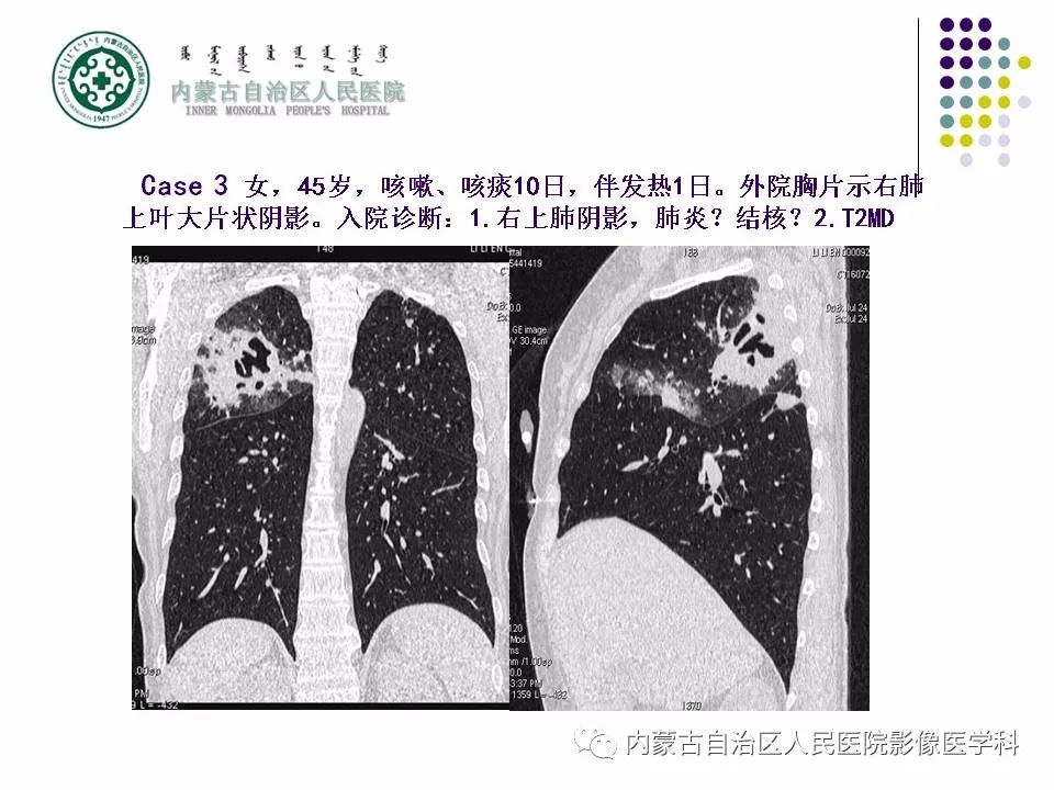 影像PPT - 【PPT】肺空洞性病变鉴别诊断-48