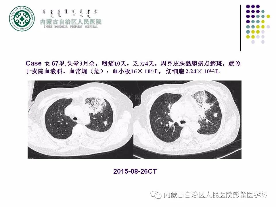 影像PPT - 【PPT】肺空洞性病变鉴别诊断-52
