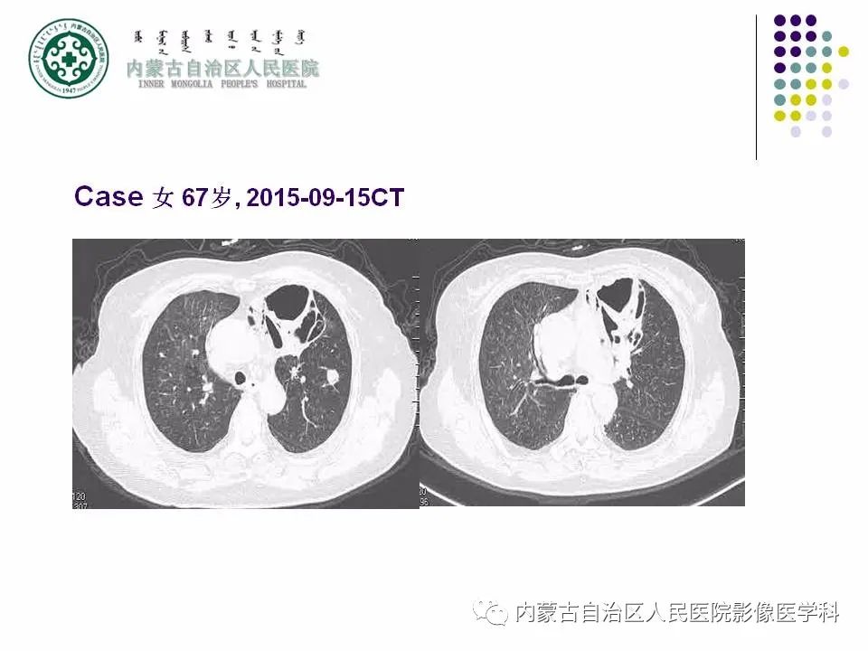 影像PPT - 【PPT】肺空洞性病变鉴别诊断-53