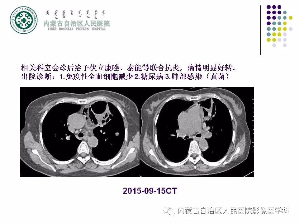 影像PPT - 【PPT】肺空洞性病变鉴别诊断-54